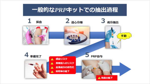 一般的なPRPキットでの抽出過程